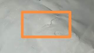 杭州一女童肛周现白色粉末 确诊蛲虫感染