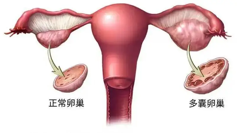 终于改名！这个病困扰全球1.7亿女性，却被“叫错”90年