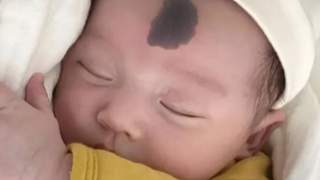 胎记怎么来的？妇产科医生提醒孕期避开这4个行为 减少新生儿胎记几率