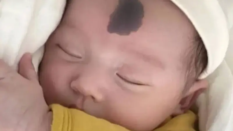 胎记怎么来的?妇产科医生提醒孕期避开这4个行为 减少新生儿胎记几率