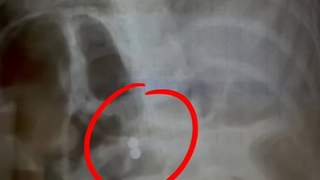 三岁男童误吞磁力珠，奶奶说大便会拉出，医生邻居紧急呼吁送医