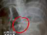 三岁男童误吞磁力珠,奶奶说大便会拉出,医生邻居紧急呼吁送医