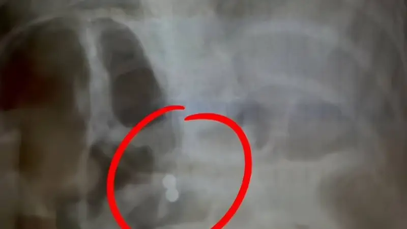 三岁男童误吞磁力珠,奶奶说大便会拉出,医生邻居紧急呼吁送医