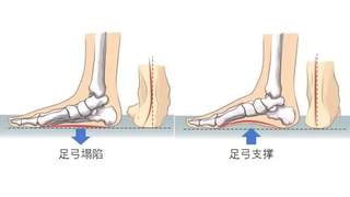 这6款网红鞋别乱穿 伤害足部健康风险高