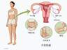 杭州一女子常被误认怀孕,腹中竟藏着50颗子宫肌瘤