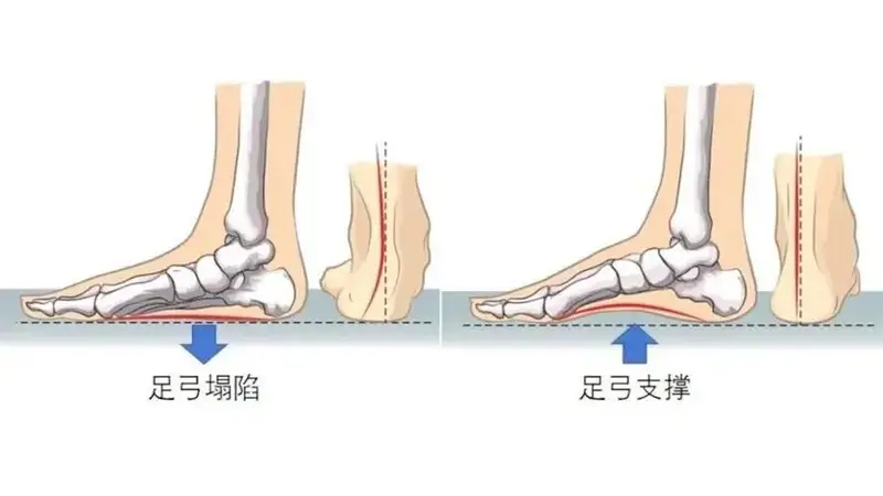 这6款网红鞋别乱穿 伤害足部健康风险高