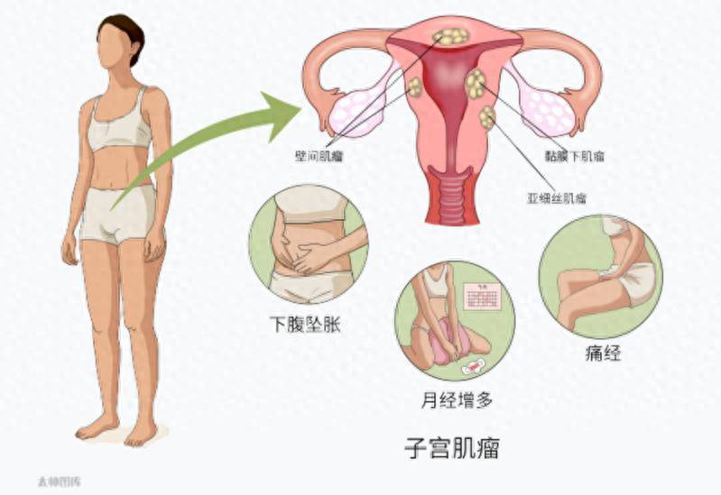 杭州一女子常被误认怀孕,腹中竟藏着50颗子宫肌瘤